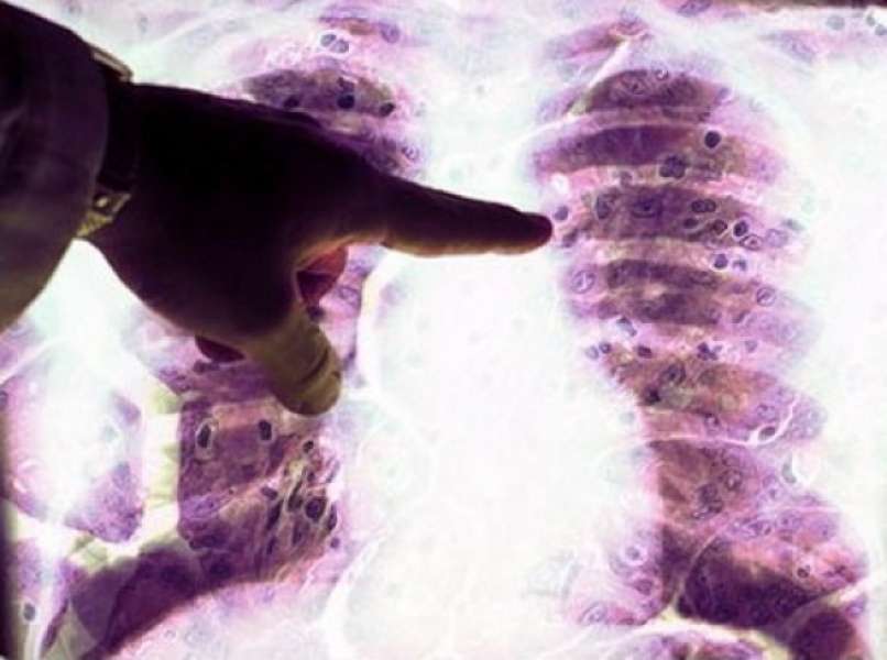 azbestoza azbest pljuča bolezen anhovo tony