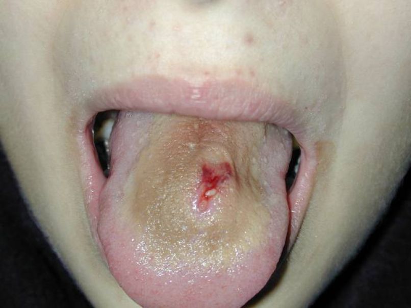 jezik strela piercing