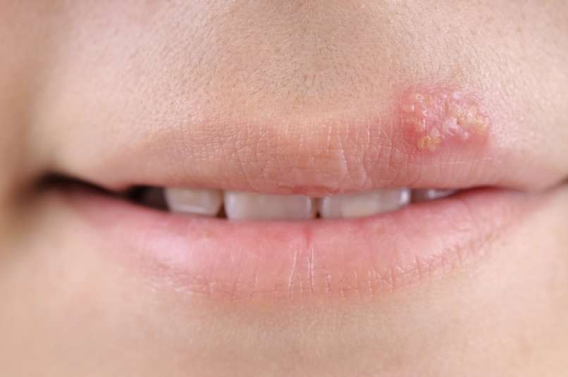herpes-simplex