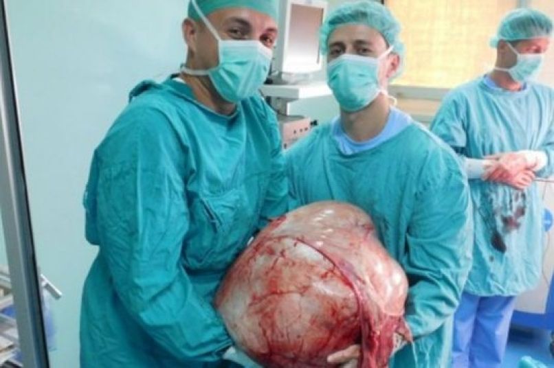 kirurgi odstranili tumor 31 kilogramov Banka Luka
