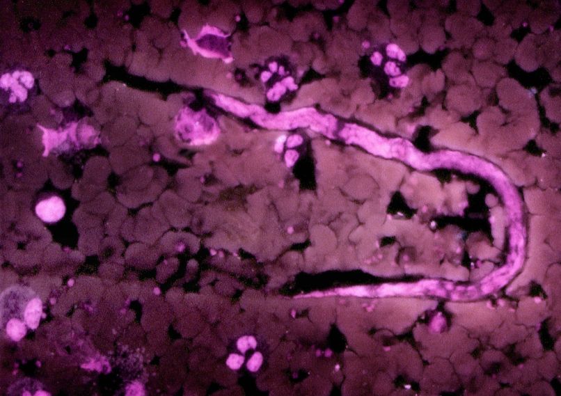 Onchocerca volvulus