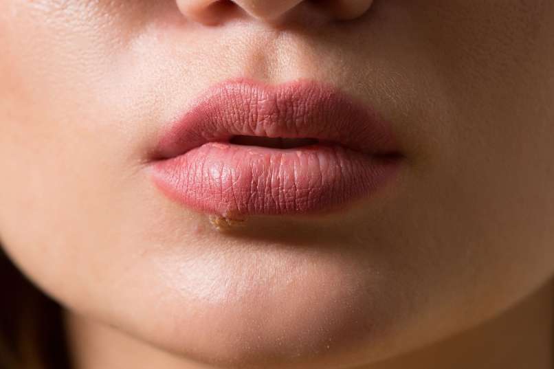 herpes