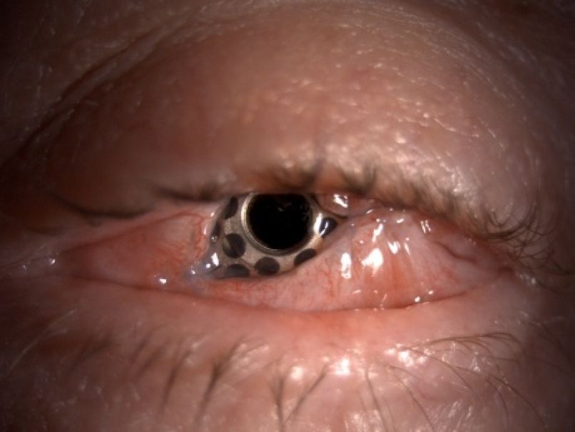 UKC Ljubljana_implantacija umetne roženice