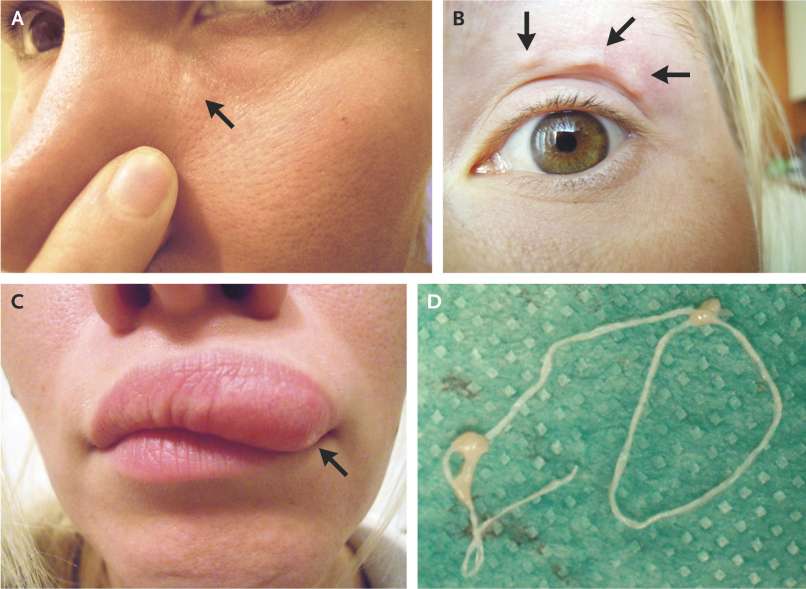 parazitski črv, parazit, Dirofilaria repens