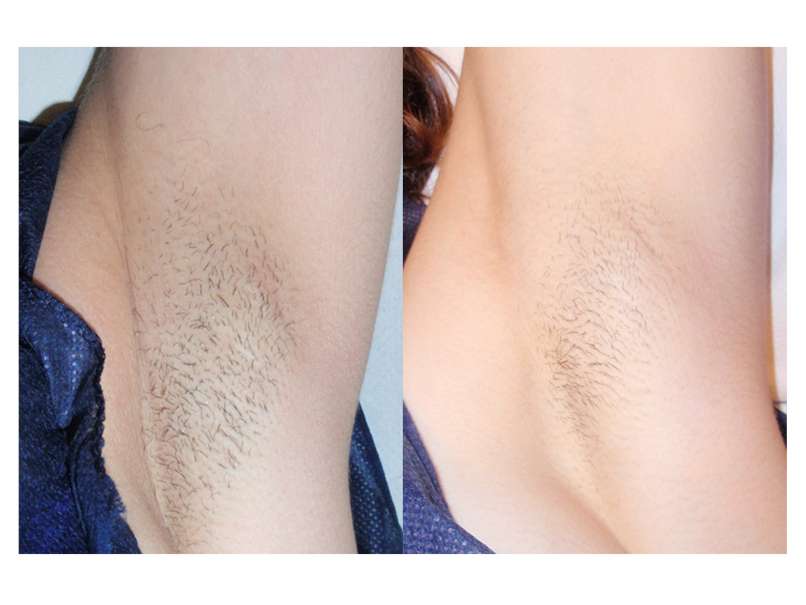 Armpits_before and after