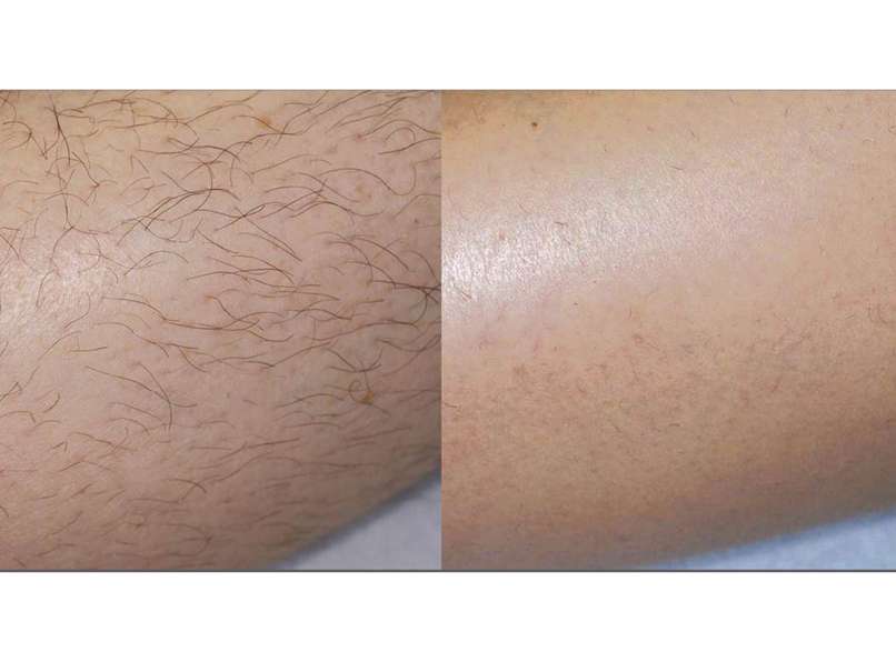 Hairy