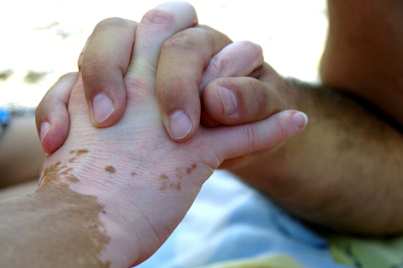 vitiligo, roke