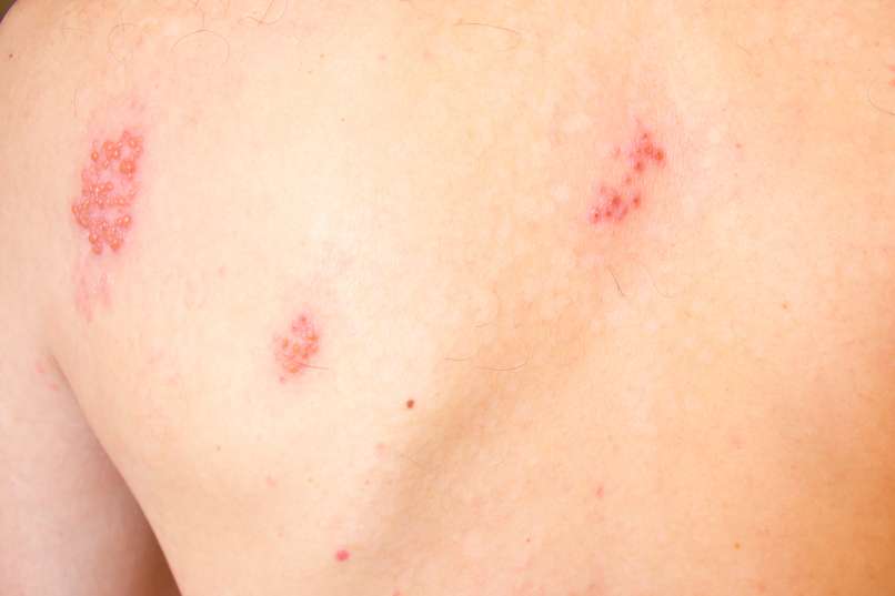 pasasti izpuščaj, herpes zoster