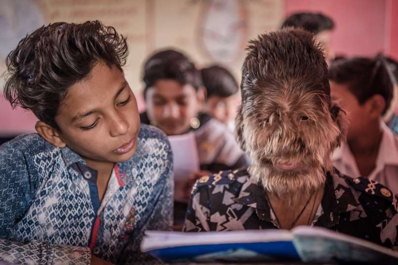 Lalit Patidar, sindrom volkodlaka