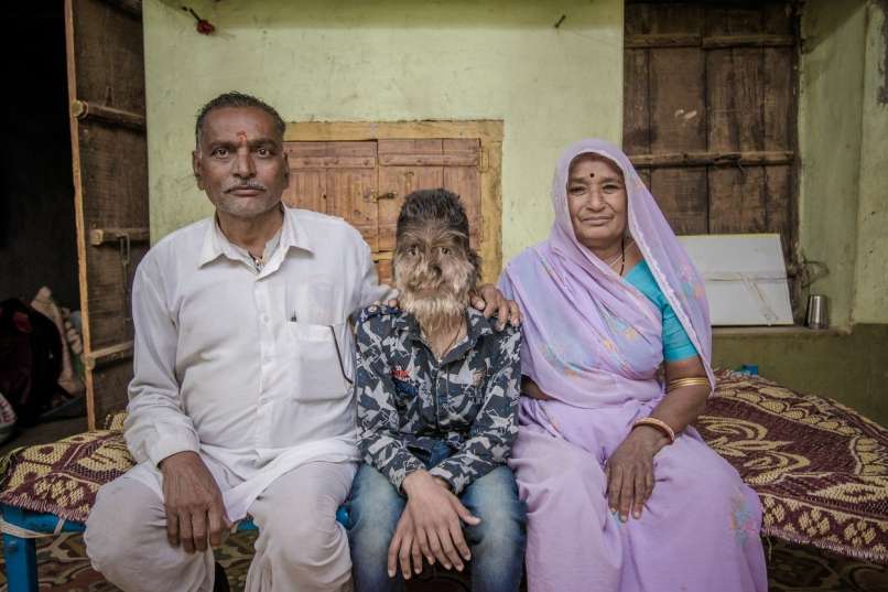 Lalit Patidar, sindrom volkodlaka