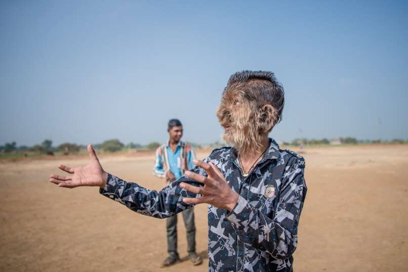 Lalit Patidar, sindrom volkodlaka