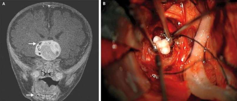 možganski tumor, zob