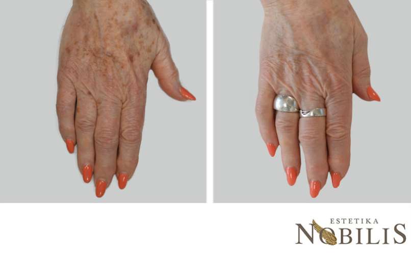 nobilis-before-after-pigmentacij-4330ae2fec