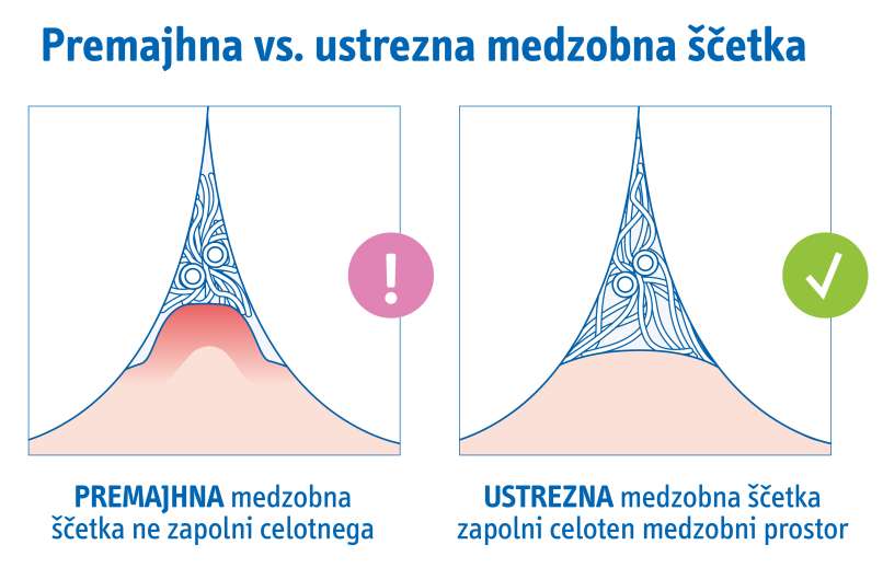 Priloga 7_ilustracija_medzobne ščetke_premajhna_ustrezna_prečni prerez