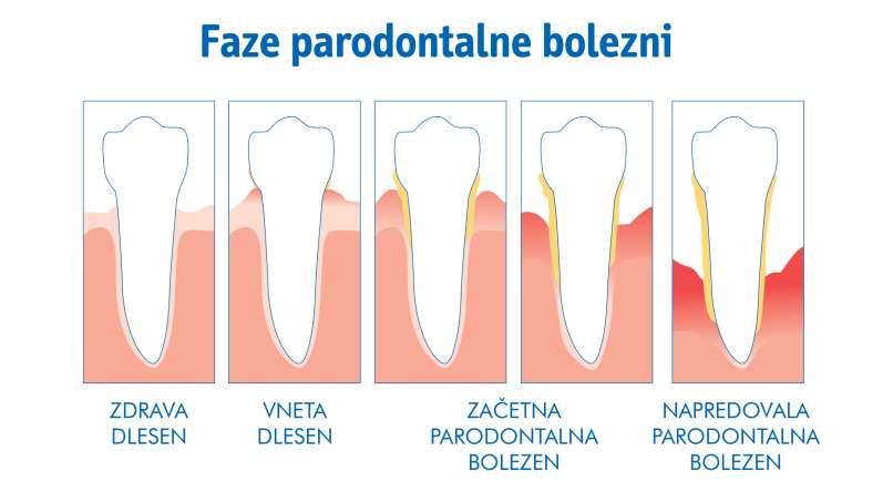 Faze-parodontalne-bolezni-ilustracija-16-9