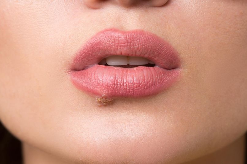herpes