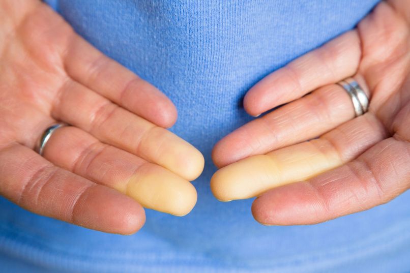 skleroderma
