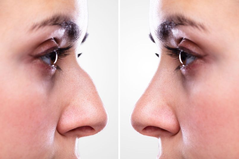 rinoplastika