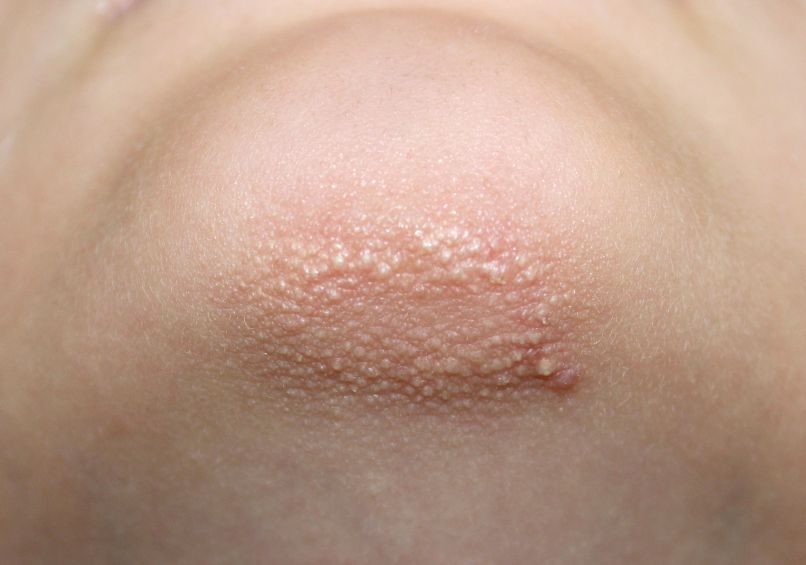 keratoza pilaris