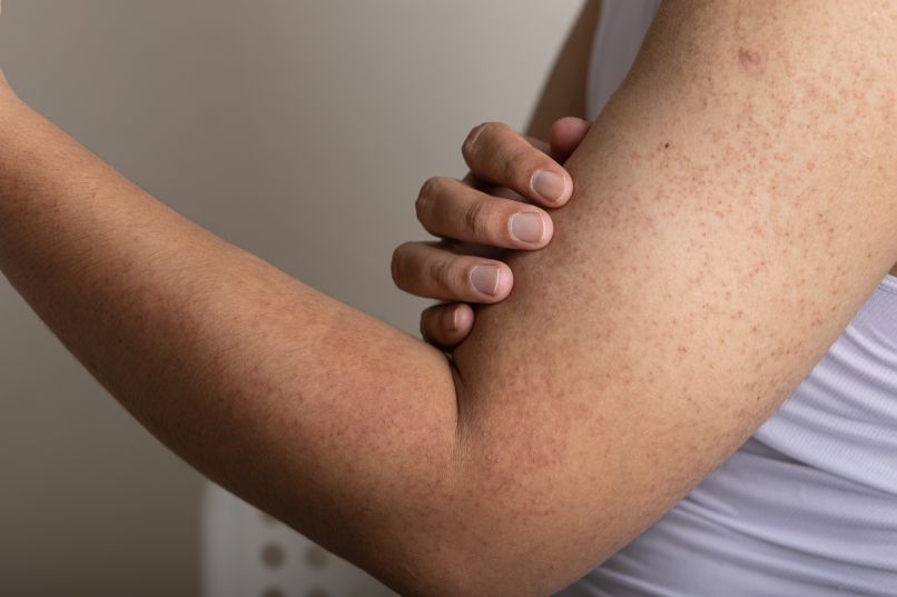 keratoza pilaris, pikice, roke, izpuščaji, koža