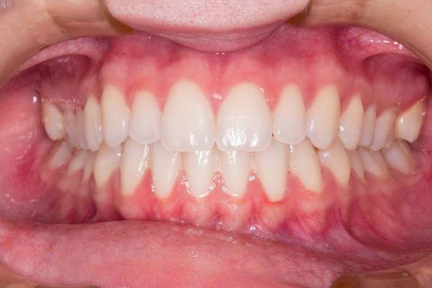 ZPStest »belilnih« zobnih krem: Bleščeče beli zobje le prazna obljuba? 