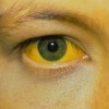hepatitis simptomi.jpg
