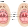 Gonorrhea8.jpg