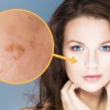 melasma.jpeg