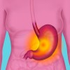 gastritis profimedia.jpg