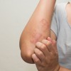atopic-dermatitis-.jpg