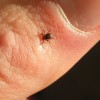 Meningitis