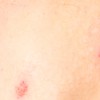 pasasti izpuščaj, herpes zoster