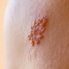 herpes2.jpg