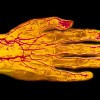 Arterial aneurysm roka profimedia.jpg