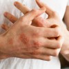 atopijski-dermatitis