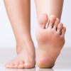 hallux-valgus-zdravljenje-fizioterapija