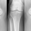 osteoporoza