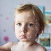 herpes zoster, pasavec, norice