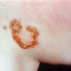impetigo (2).jpg
