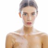 vitiligo