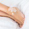 vitiligo