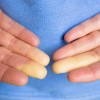 skleroderma