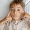 konjunktivitis