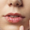 herpes, sonce