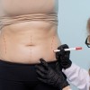 liposukcija