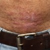 alergijski-kontaktni-dermatitis