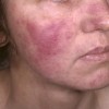 lupus, izpuščaj na obrazu
