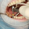 implantat