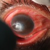 Akantamebni keratitis.jpg