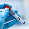 test-rak-prostate